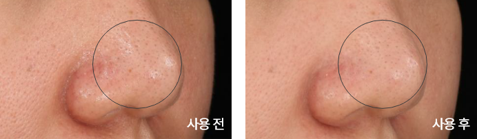 blackhead change